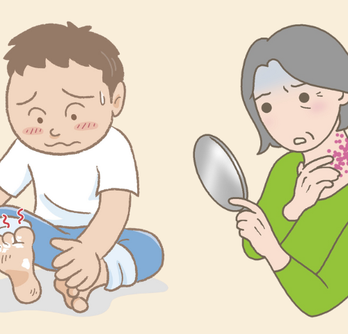 50代からは皮膚感染症に注意!「帯状疱疹」や「水虫」はうつる?家庭内で予防するポイントは【医師解説】
